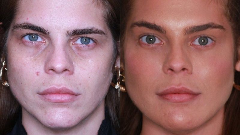 Göz Altı Işık Dolgusu Ve Elmacık Kemiği Dolgusu Kombinasyonu En Çok Tercih Edilen Uygulama