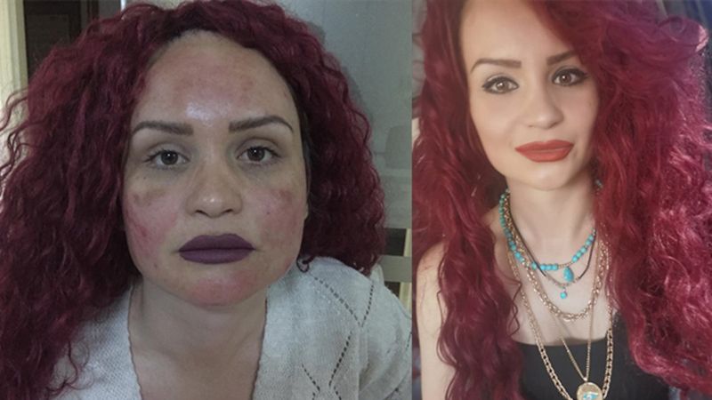 İzmit'te leke tedavisinde yüzü yandı