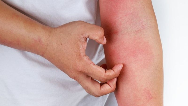 Salgında uyuz vakaları arttı