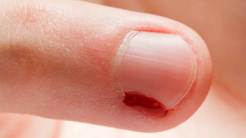 Ellerdeki iltihap riski: Şeytan tırnağı nedir? Şeytan tırnağı neden çıkar?