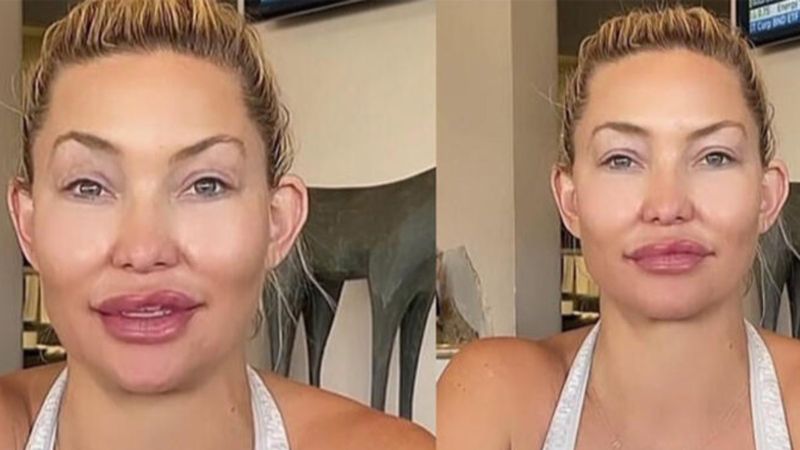 Kate Hudson'un botoks filtresi