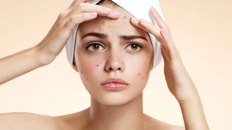 Diyet ve stres akne oluşumuna etki edebiliyor