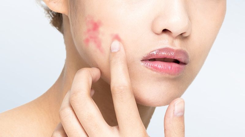 Maske kullanımı ‘Gül’ hastalığını tetikliyor