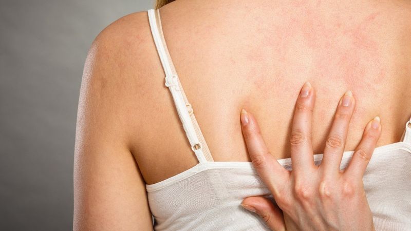 Aşırı stres ve kaygı zona hastalığını tetikliyor