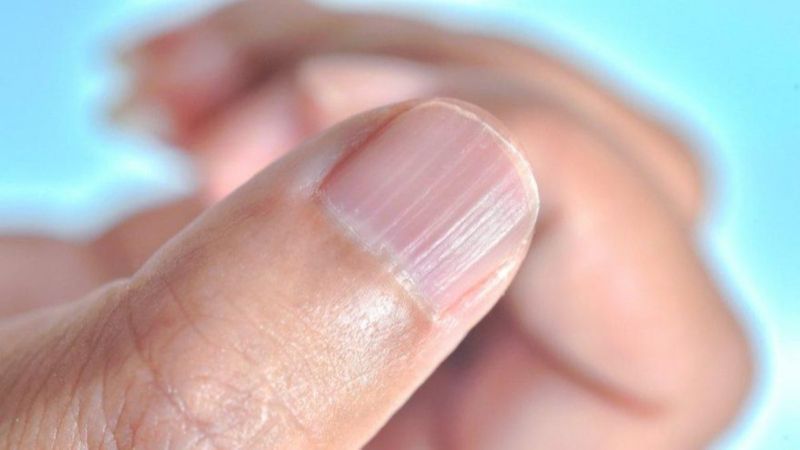 Demir eksikliğinin 10 işareti