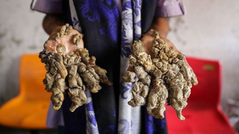 Dünyadaki en nadir hastalıklar