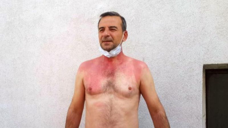 Edirne'de komşusunun üzerine kaynar su döktü