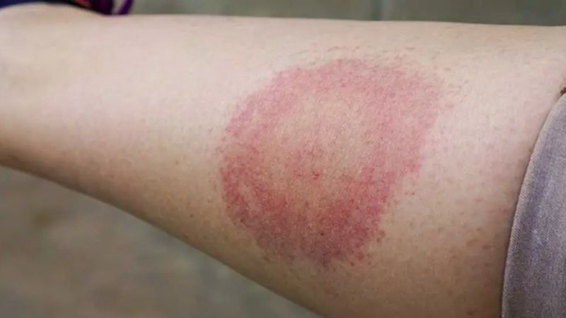 Semptomları Covid-19'la aynı: Kırım Kongo Kanamalı Ateşi belirtileri nelerdir?