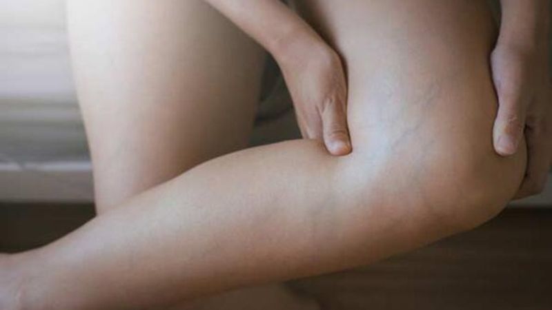 Ödem oluşumunu önlemek için 8 ipucu