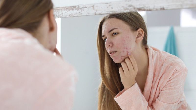 Akne oluşumu gençlerde mutsuzluk sebebi