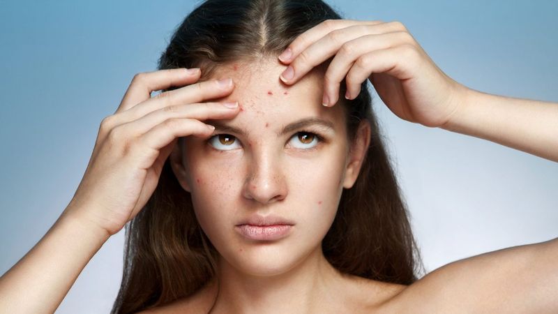 Sivilce tedavisinde dikkat edilecek noktalar