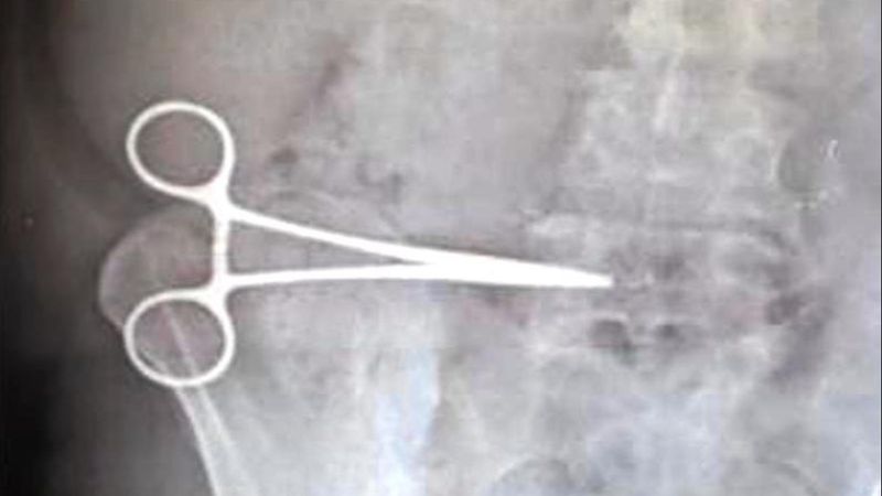Aydın'da karnında unutulan makasla iki ay yaşadı