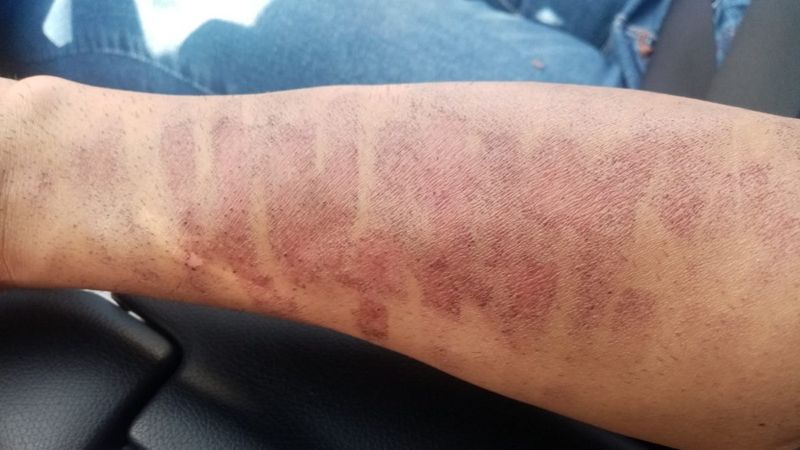 Kahramanmaraş'ta lazer epilasyonda kolları yandı