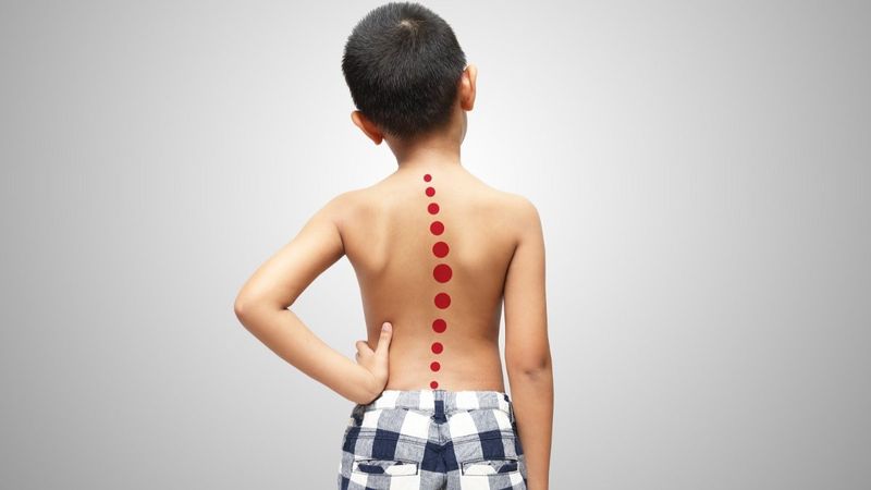 Uzmanından ergen çocuklu ailelere ‘skolyoz’ uyarısı