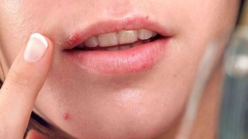 Zayıf bağışıklık, çocuklarda uçuk oluşumunu tetikliyor