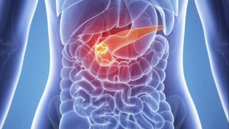 Pankreas kanserinin 4 erken belirtisi