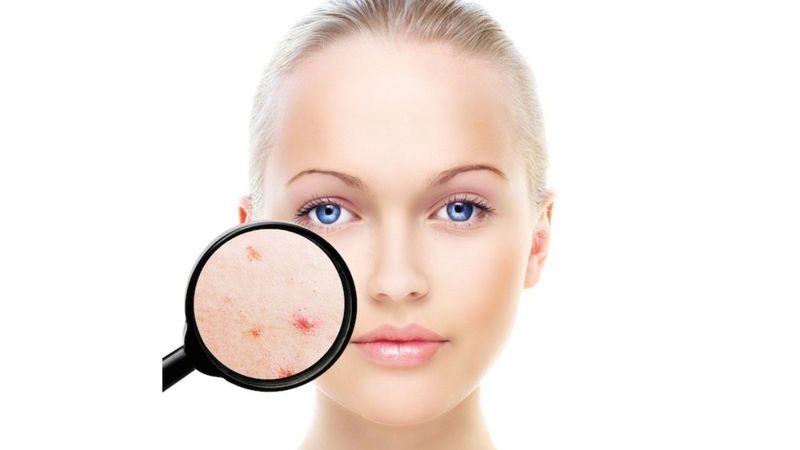 Akne gelişimine bazı bireylerin yatkınlığı olabilir