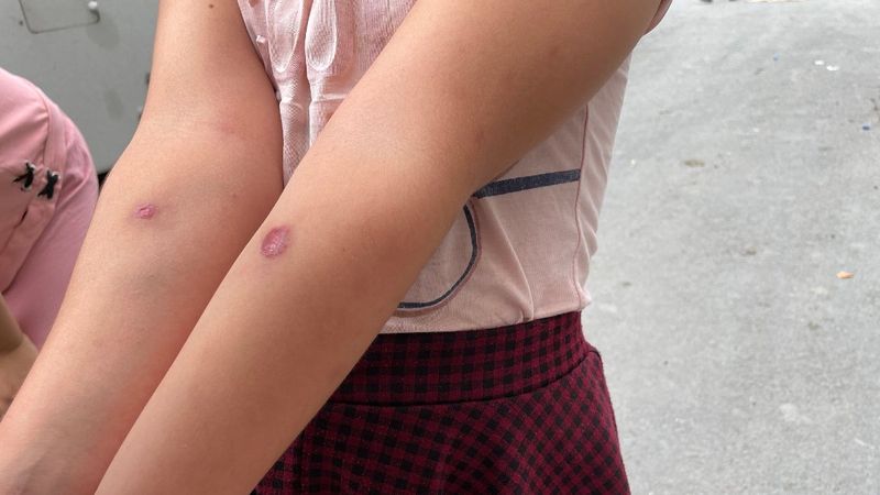 Avcılar’da sivrisinek ısırıkları ile çocuklarda oluşan yaralar paniğe neden oldu