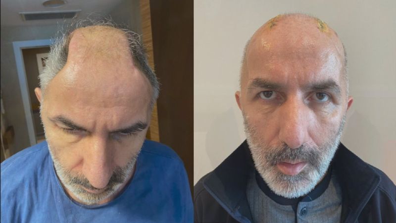 İstanbul’da kafatası kemiklerini aylarca karnında taşıdı