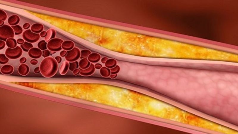 Sessiz bir düşman: Çocukluk kolesterolü
