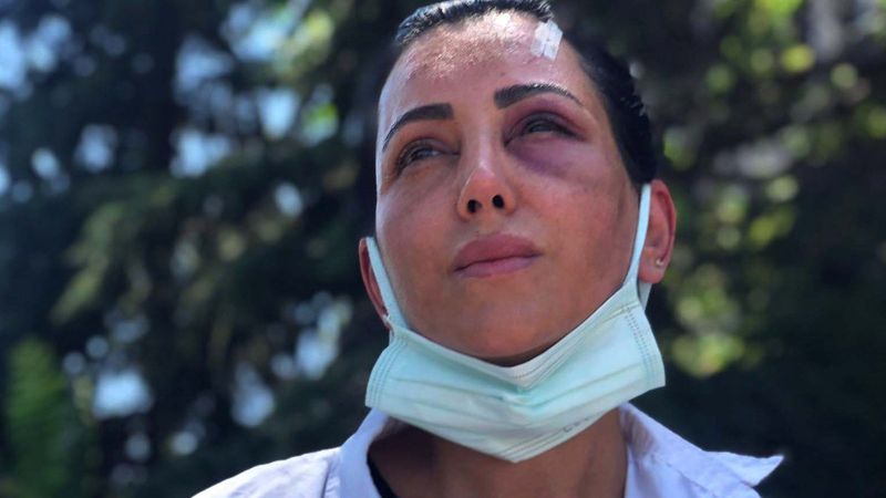 Ankara'da eski sevgilisi tarafından darbedildi