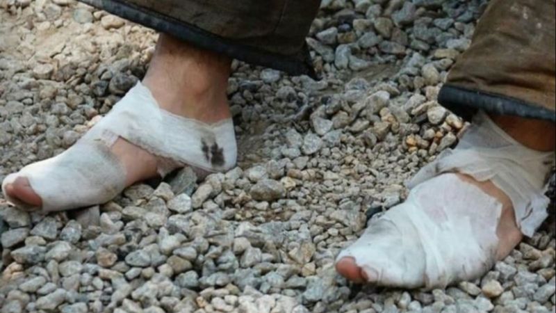 Ayakları sargı içinde olan personel, yangın bölgesinden ayrılmadı