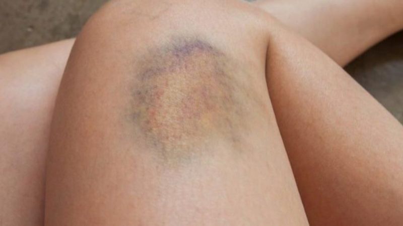 Vücudunuzdaki nedensiz morlukları es geçmeyin