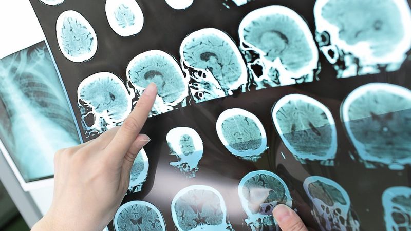 Beyin tümörü belirtileri ve tedavisi