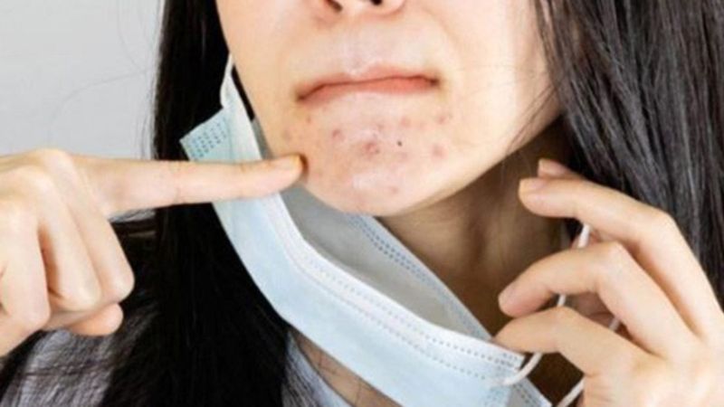 Çift maske kullanımı 'maskne'yi tetikliyor