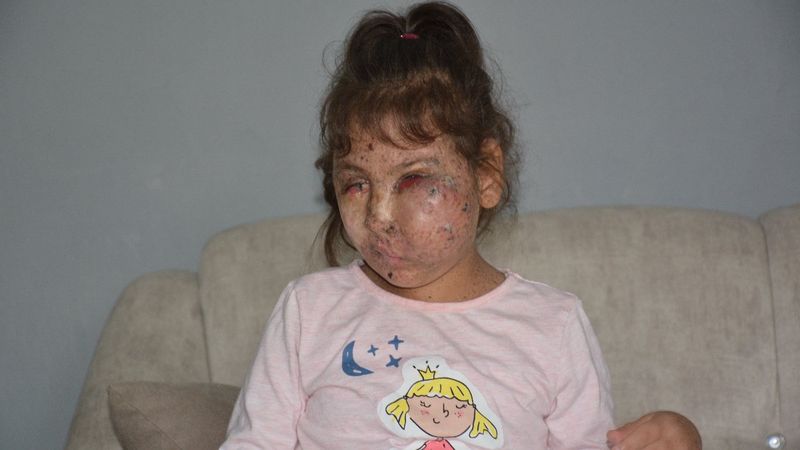 Karabük'te Mikrosefali hastası Sahra, yardım bekliyor