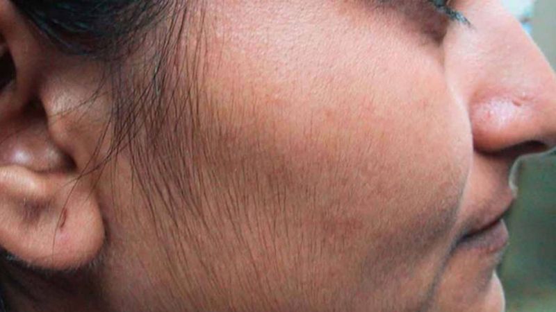 Aşırı tüylenme ile kendini gösteren hastalıklar