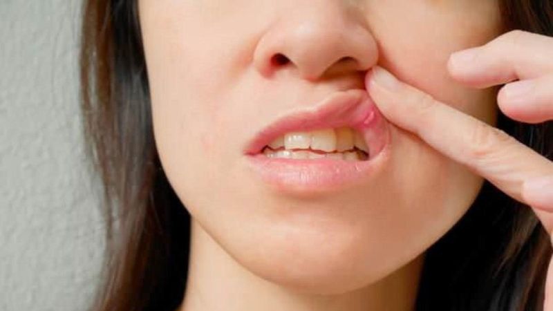 Ağız yaralarını hafifletmek için 5 doğal çözüm