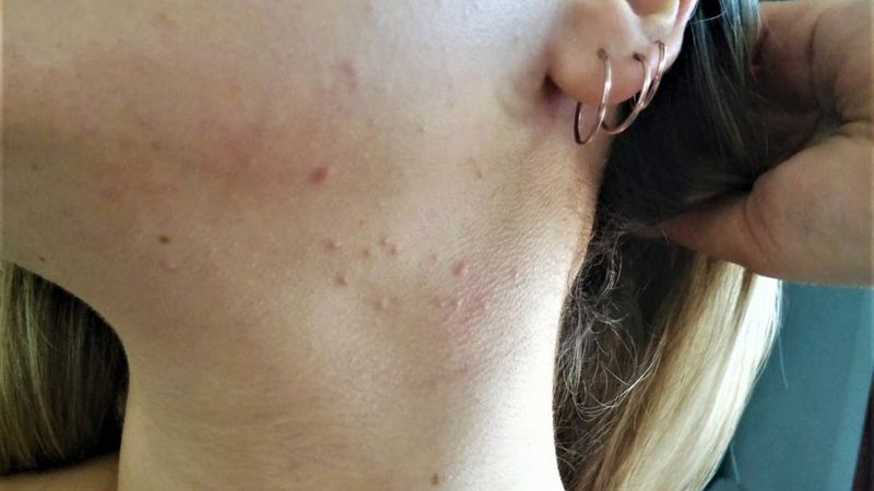 Kaşıntı ve kabarıklığa neden olan ter alerjisine karşı uyarı yapıldı