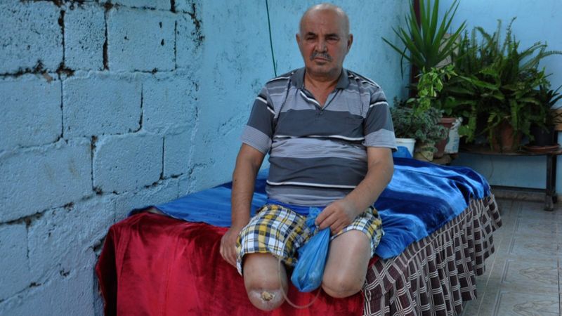 Gaziantep’te, ayakları kesilen adamın akülü sandalye çağrısı