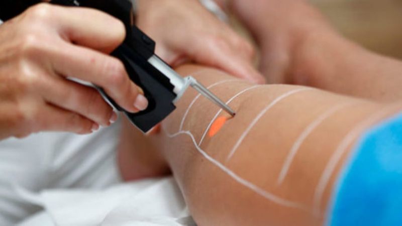 Lazer epilasyon yasaklandı mı? Danıştay'dan güzellik merkezlerine kötü haber