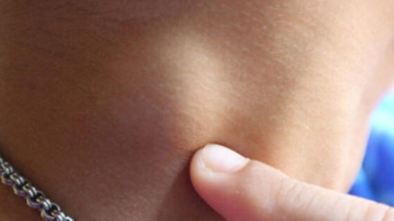 Lenf bezi şişmesi nasıl anlaşılır