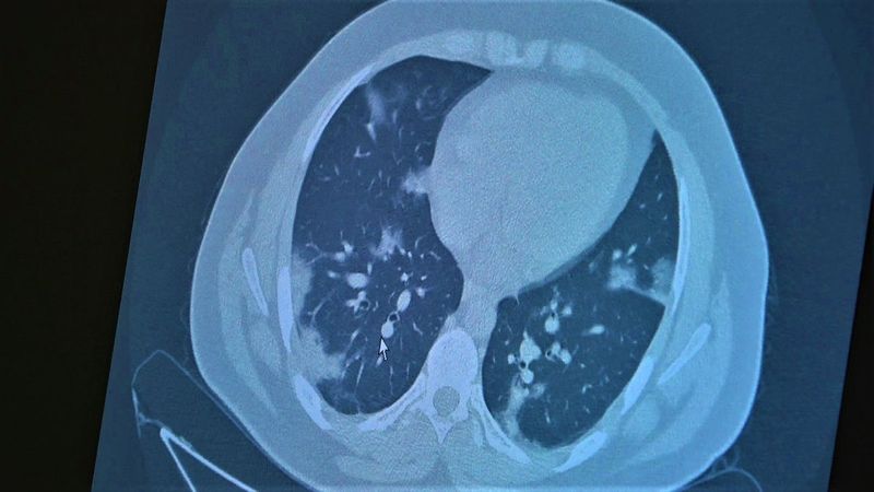 Koronaya yakalanan 15 yaş altı çocuklarda ciddi akciğer tutulumları görüldü