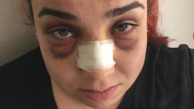 İzmir’de, işvereni tarafından burnu kırıldı