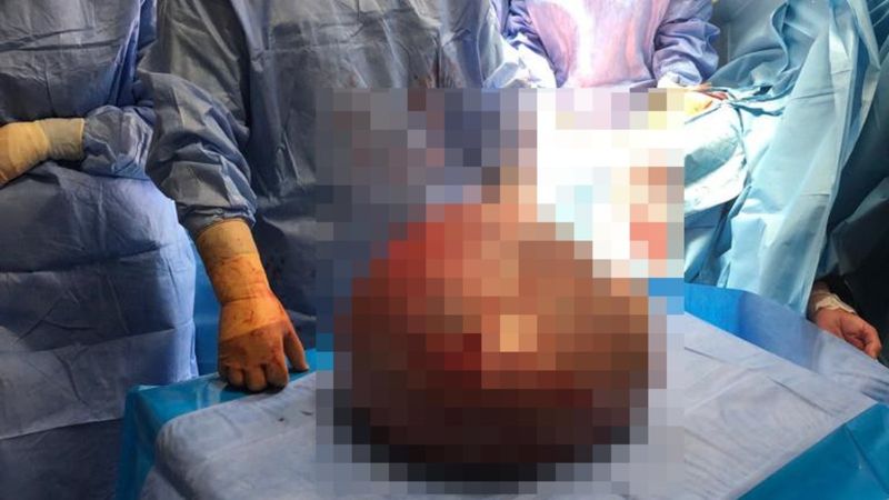 Sakarya'da karnından 18 kiloluk kitle çıktı