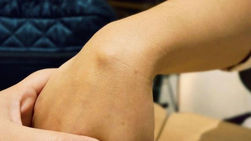 El bileğinizi kontrol edin: Ganglion kisti nedir, nasıl anlaşılır?