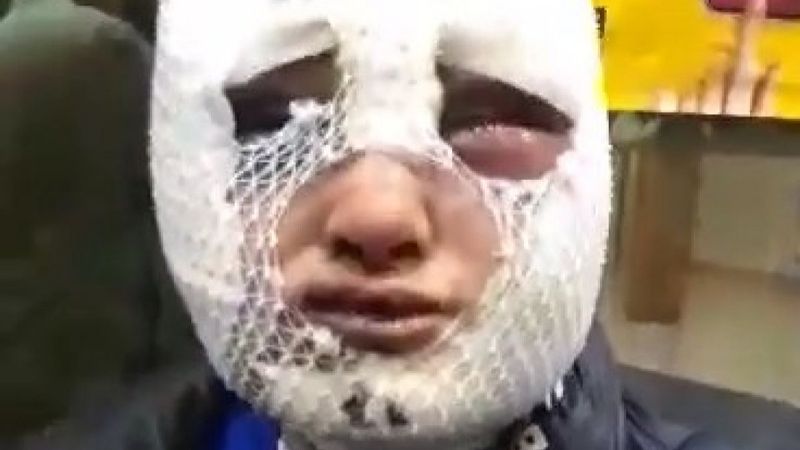 Hatay'da eski sözlüsü tarafından darbedilip, başından aşağı kızgın yağ döküldü