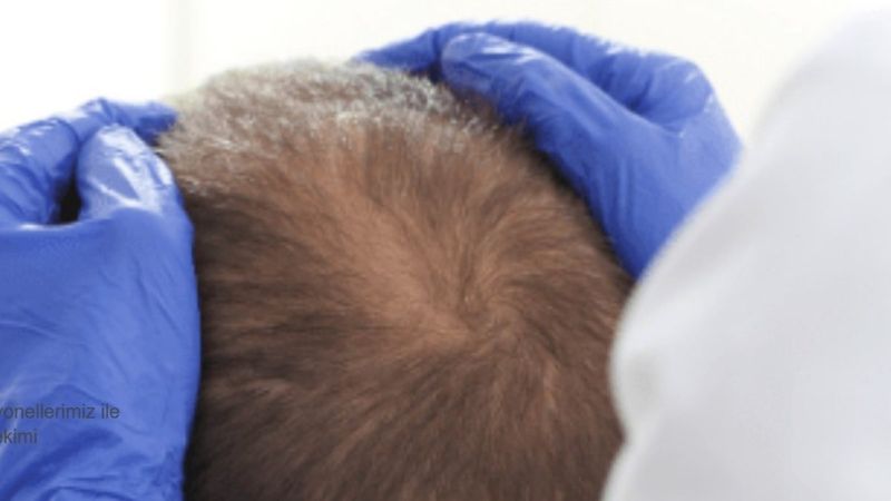 Saç Ekimi Sonuçları Ne Zaman Alınır?