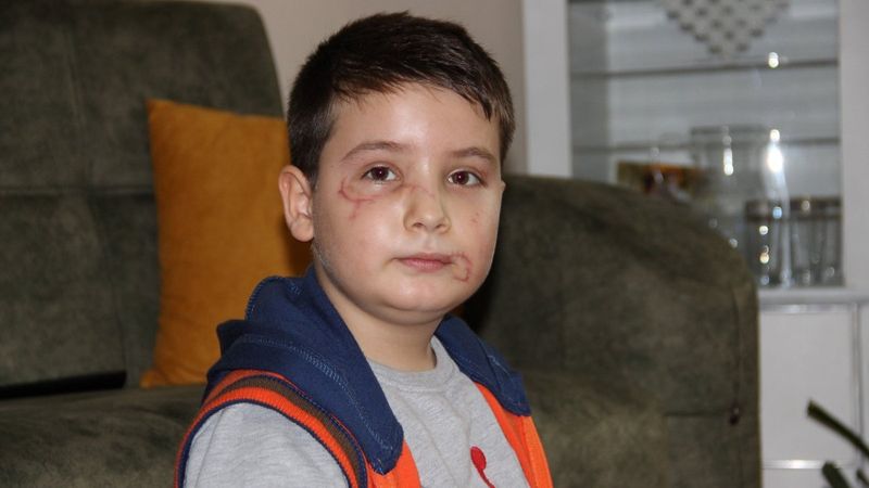 Manisa'da köpek saldırısına uğrayan Mert, travma yaşıyor