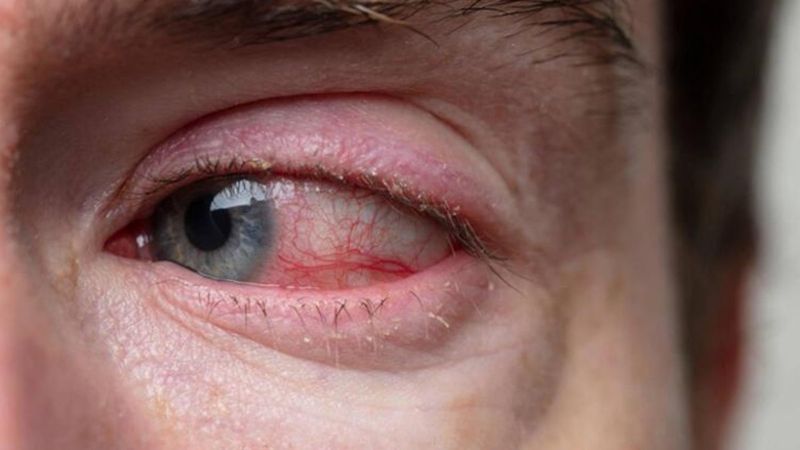 Kaşıntı, yanma, kızarıklık! Gözlerde 'adenovirüs' semptomları....