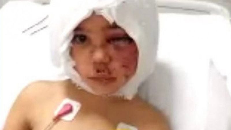 Pitbullların saldırısına uğrayan Asiye ikinci ameliyata hazırlanıyor