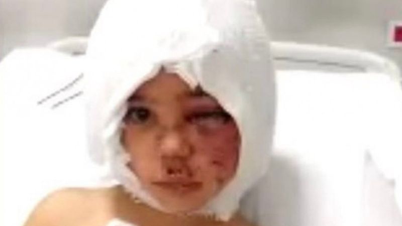 Pitbull saldırısına uğrayan Asiye’nin yüz felci olduğu belirtildi