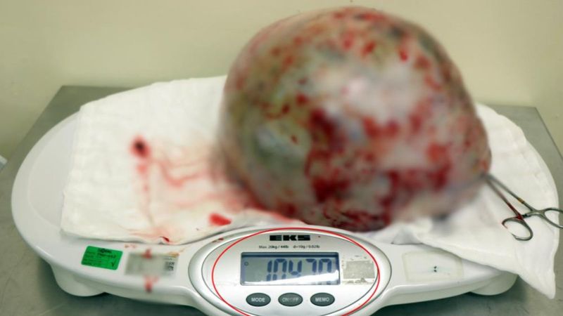 Samsun’da, kadının karnından 10 kilo 470 gram kitle çıkarıldı