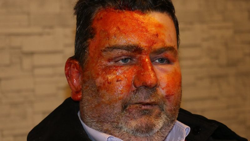 Sakarya'da, uykudayken yüzüne yanıcı madde döküldü