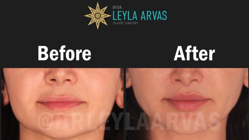 Dudakların mükemmelini yakalayan ikili! Size hangi dudak dokunuşu uygun Liplift mi Dudak dolgusu mu?