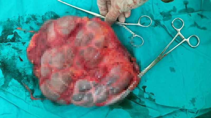 Denizli'de idrar kesesine dönüşen böbrek ameliyatla alındı